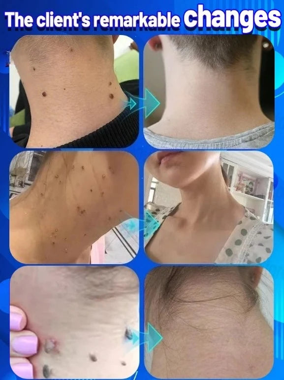 Mini Lᴀsᴇʀ ᵂᵃʳᵗ ᴿᵉᵐᵒᵛᵉʳ Pᴇɴ - Painless & Efficient Removal, Essential for ᴰᵃⁱˡʸ Skin Care